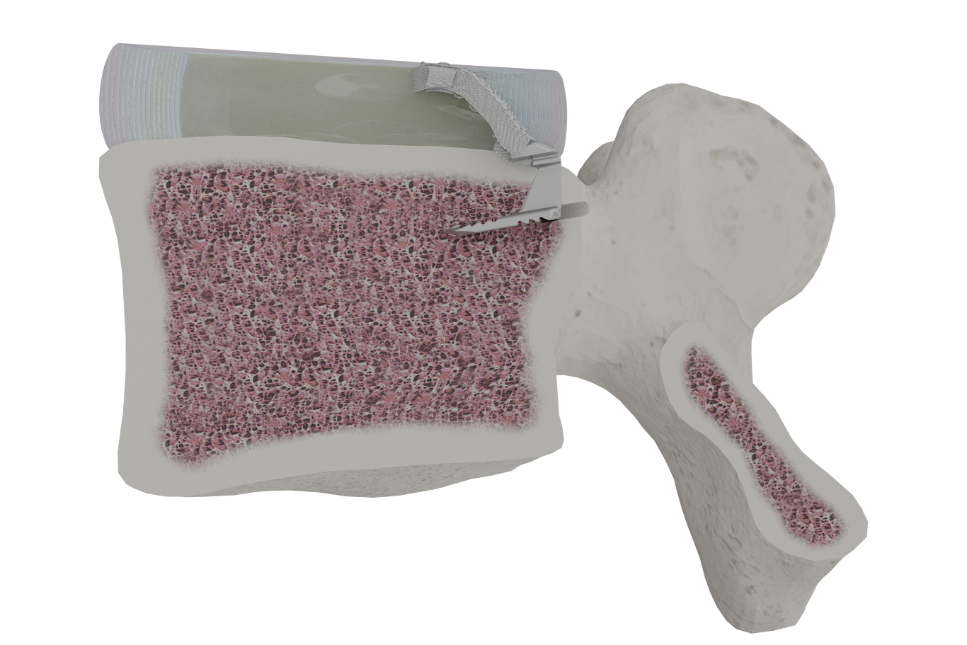 Barricaid Surgery