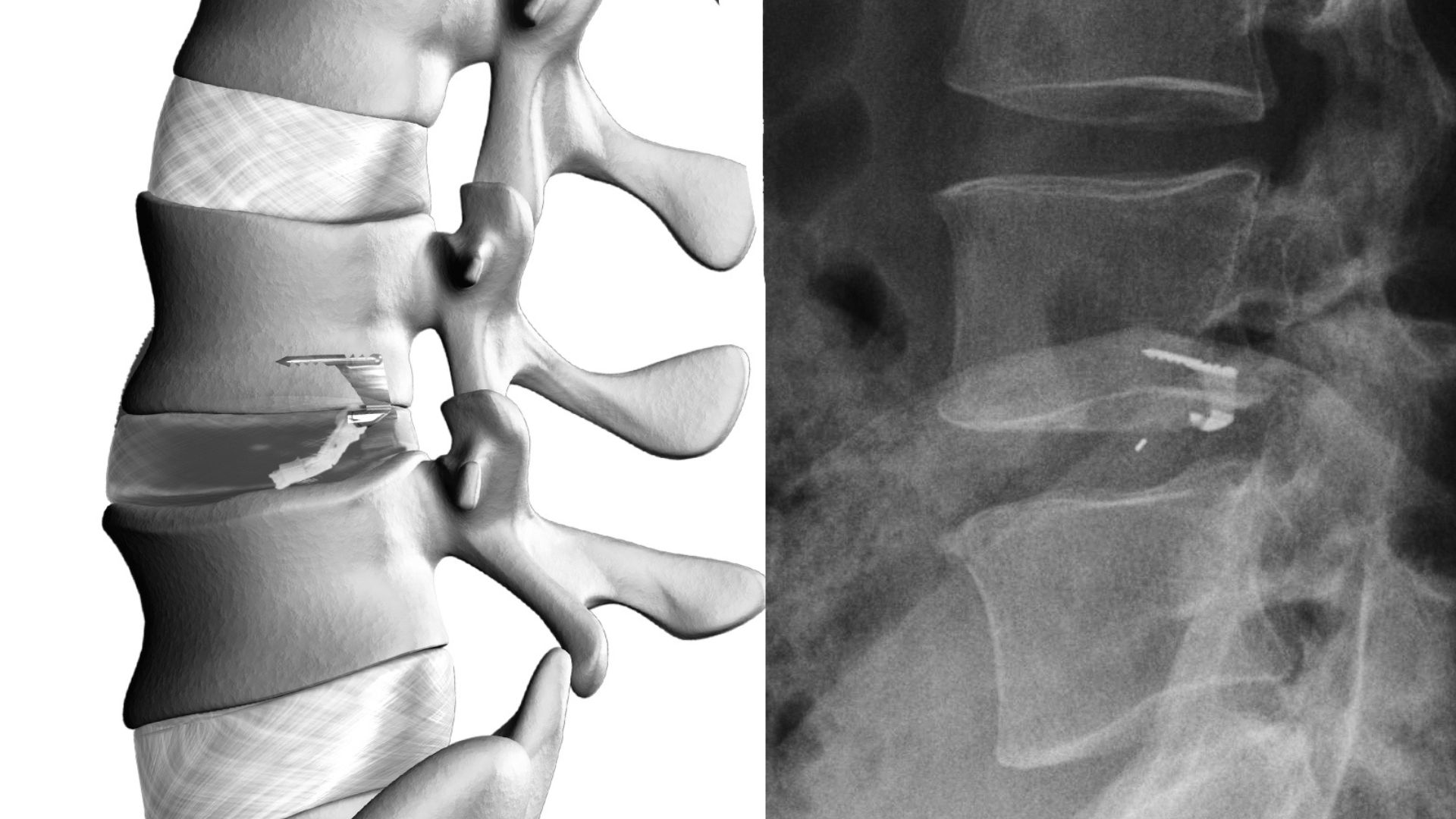 How the Barricaid Implant Helps Prevent Reherniation for Boise Patients After Lumbar Discectomy